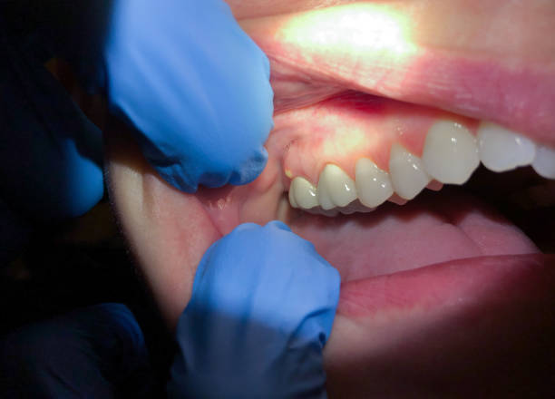 Best Emergency Dentist for Knocked-Out Tooth in Woodworth, LA